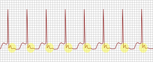 תרשים מוניטור המציג Fast-slow AVNRT. מודגשים בצהוב גלי ה-P הנמצאים לאחר קומפלקס ה-QRS.