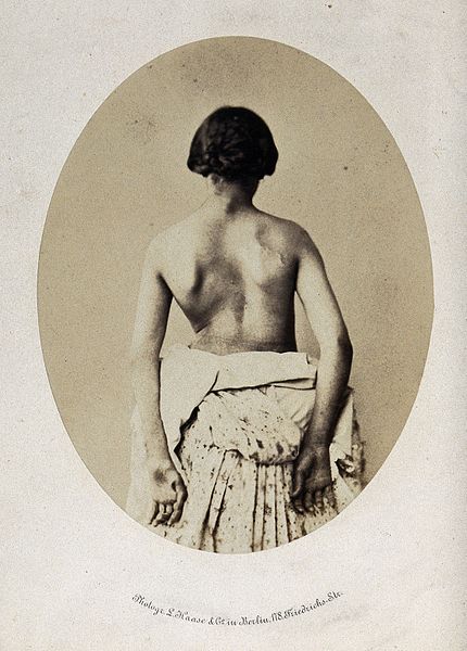 File:A woman with her back unclothed. Photograph by L.Haase after Wellcome V0029429.jpg