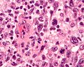 未分化大細胞型リンパ腫のサムネイル