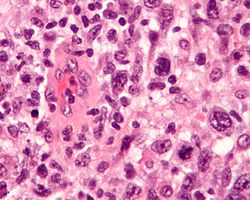 Anaplastic large cell lymphoma - cropped - very high mag.jpg