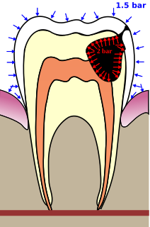 Barodontalgia Tooth pain caused by ambient pressure change