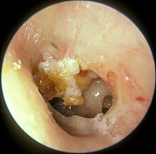 Cholesteatoma and large perforation left ear drum