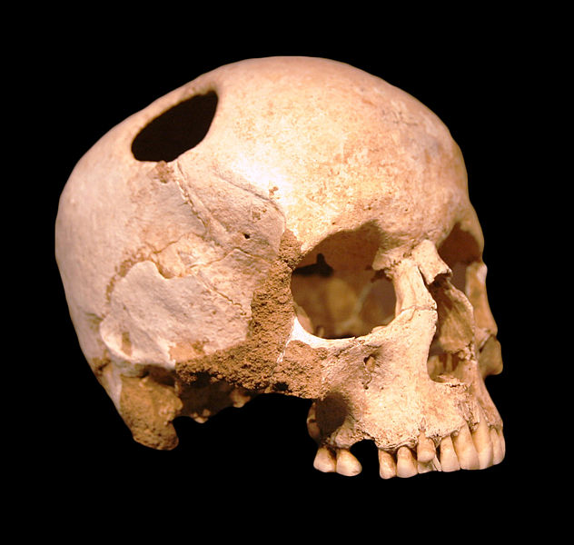 File:Crane-trepanation-img 0507 crop.jpg