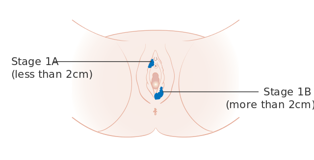 File:Diagram showing stage 1A and 1B cancer of the vulva CRUK 195.svg - Wik...