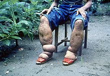 רגליים נפוחות כתוצאה ממחלת האלפנטיאזיס (לוזון, הפיליפינים)