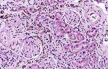 Hemosiderin image of a kidney viewed under a microscope. The brown areas represent hemosiderin Hemosiderin1.jpg