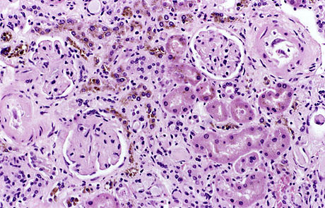 Hemosyderoza