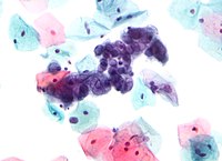 Вірус простого герпесу (оптична фотомікроскопія). Фарбування по Папаніколау, віріони темно-синього відтінку забарвлення.