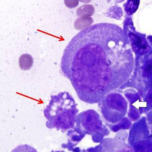 Mott cells with Russell bodies (red arrows), compared to an almost normal plasma cell (white arrow; it has a prominent nucleolus). Histopathology of Mott cells with Russell bodies.png