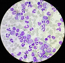 Chronic myeloid leukemia in a 4 years old female. Peripheral blood (MGG stain) LMC4.jpg