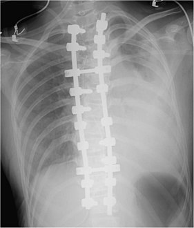 Showing a massive left-sided hemothorax