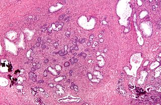 <span class="mw-page-title-main">Transurethral resection of the prostate</span> Surgical procedure to perform a prostatectomy