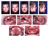 Patient with Apert syndrome.jpg