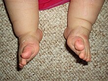 Clubfoot Wikipedia