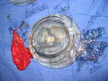 A breast implant failure: the parts of a surgically explanted breast implant are the red, fibrous capsule (left), the ruptured silicone implant (center), and the transparent filler-gel that leaked with the capsule (right). Ruptured implant.JPG