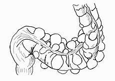 Sigmoid diverticulum (diagram).jpg