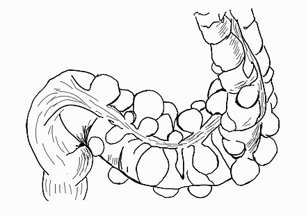 Drawing showing a sigmoid colon with many diverticula