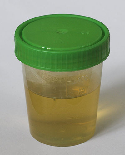 Urinalysis will be able to detect high levels of proteins and occasionally microscopic haematuria.