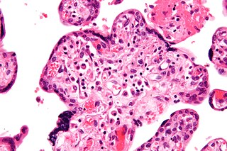 <span class="mw-page-title-main">Villitis of unknown etiology</span> Medical condition