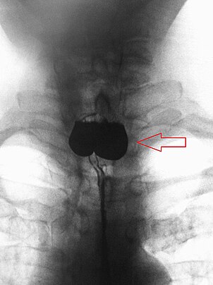 AP X-ray of a Zenker's diverticulum