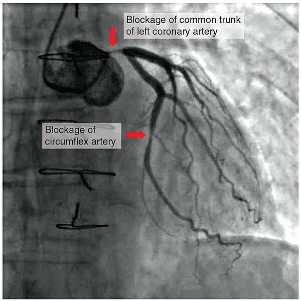 File:2016 Occluded Coronay Arteries.jpg