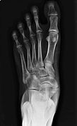 Accessory Navicular 01.jpg