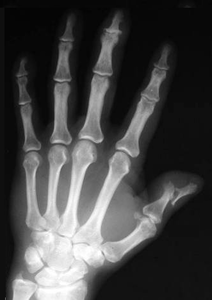 artrita primara osteoartrita articulațiilor interfalangiene distale ale mâinilor