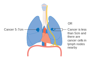 Stage IIA lung cancer