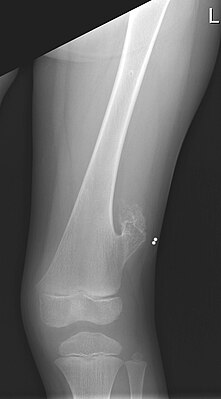 Рентген левого бедра 5-летнего мальчика с экзостозом, расположенным латерально, чуть выше колена.