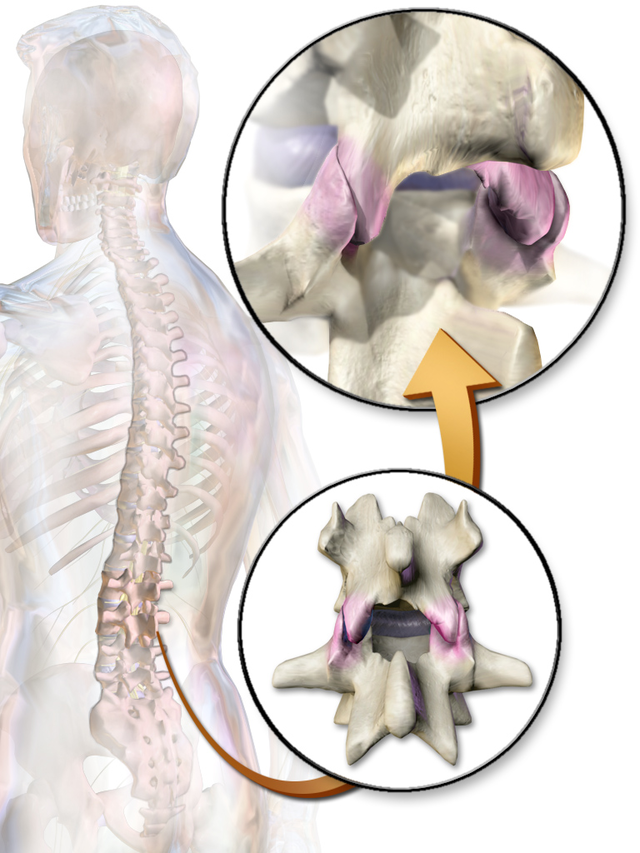 Facet syndrome - Wikipedia