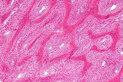 Fibrous dysplasia - intermed mag.jpg