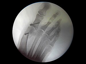 Hallux valgus or bunion radiographie radiography.jpg