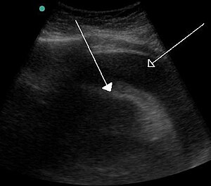 Hemorragic effusion.jpg