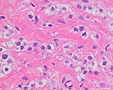 Histopathology of invasive lobular carcinoma with moderate nuclear pleomorphism.jpg