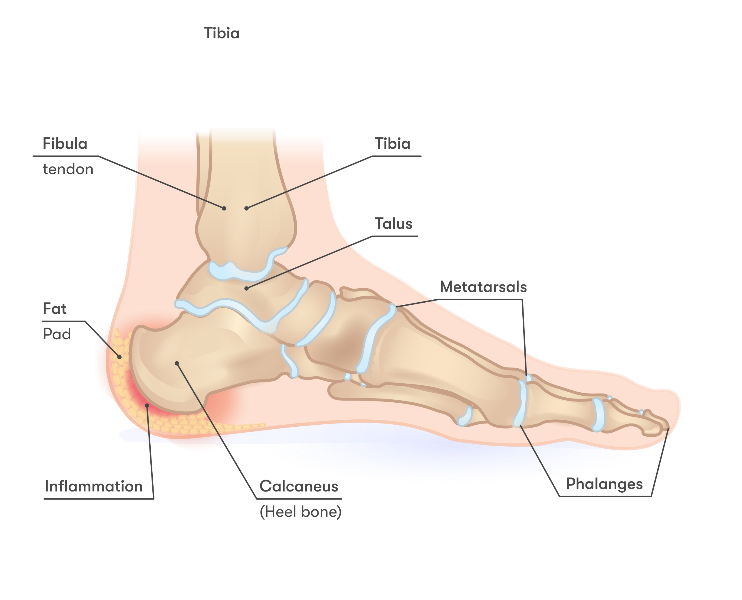 Foot Drop: What It Is, Causes, Symptoms & Treatment