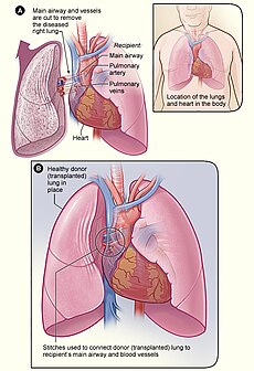 Lung transplant.jpg