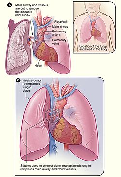 Ağciyər transplantasiyası prosesini göstərən illüstrasiya.