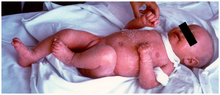 Redness and scaliness of the entire skin on a 5-month-old female infant