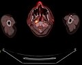 April 24: PET scan of a patient with nasopharyngeal cancer