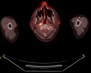 FDG-PET/CT scan of a patient with nasopharyngeal cancer. Transverse slice demonstrating FDG-positive primary site