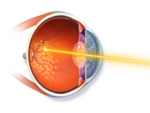 Laser photocoagulation involves using a laser to cauterize the portions of retina which are not supplied by blood vessels. Photocoagulation.png