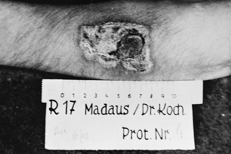 File:Results of a medical experiment with phosphorous at Ravensbrueck concentration camp.jpg