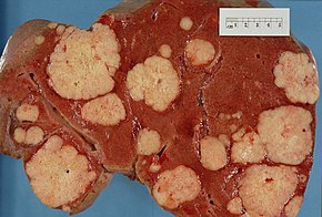 Cross-section of a human liver, at autopsy, showing many large pale tumor deposits, that are secondary tumors derived from pancreatic cancer Secondary tumor deposits in the liver from a primary cancer of the pancreas.jpg
