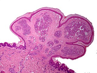 Pyogenic granuloma Vascular tumor on both mucosa and skin