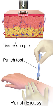 Biopsy Procedure Skin Punch Biopsy.png