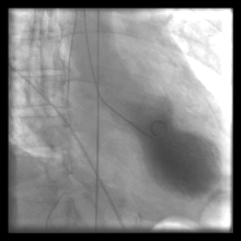 Ventrululography Takotsubo.gif