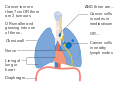 Diagram 2 of 3 showing stage 3A lung cancer CRUK 014.svg