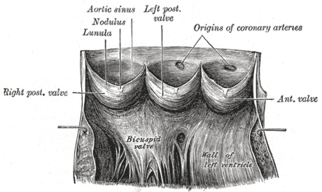 Aneurisme sinus aorta