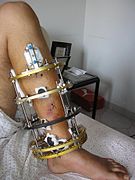 Front-left view of the Ilizarov apparatus treating a fractured tibia and fibula. The patient suffered an open fracture. It is located slightly above black metal ring. Photographs 1 through 4 are taken four weeks following the fracture and two weeks following the installation of the Ilizarov apparatus.