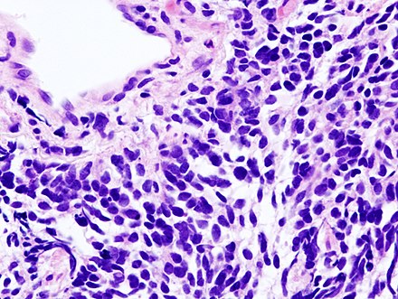Histopathologic image of small-cell carcinoma of the lung. CT-guided core needle biopsy. H&E stain.